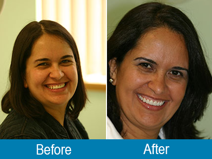 before after dental treatment