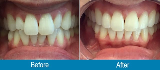 comparison of teeth before and after treatment