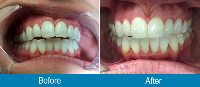 dental treatment before and after