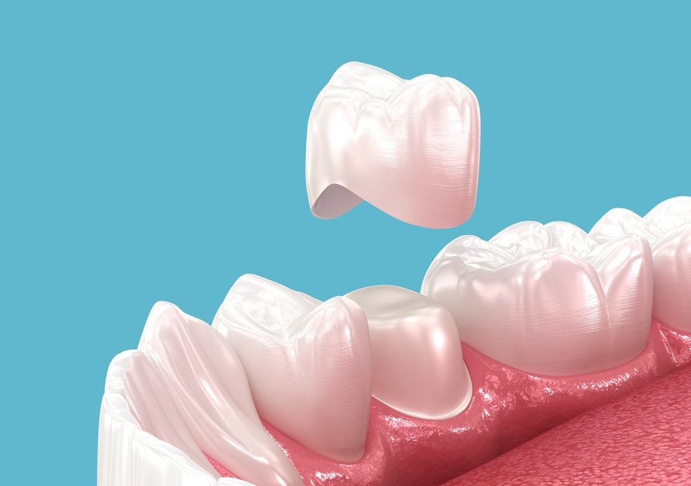 what are dental crowns? understanding the basics.