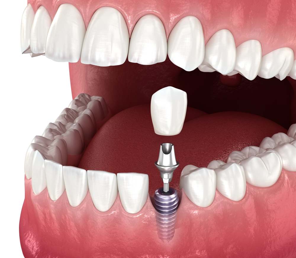 are dental implants right for you? Signs you might need them